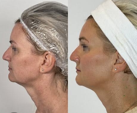 الوجه + الرقبة