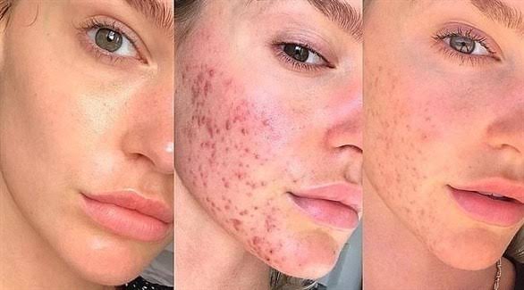 علاج حب الشباب